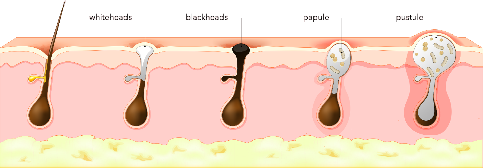 How acne develops