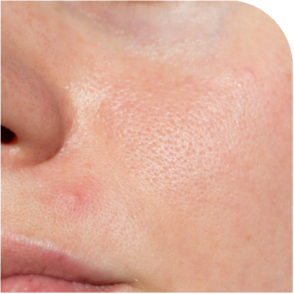 Oily Skin