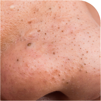 Blackhead