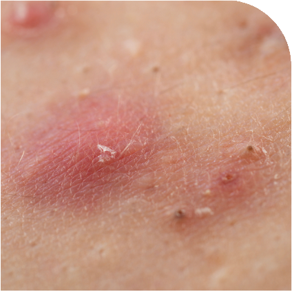 Acne Scar